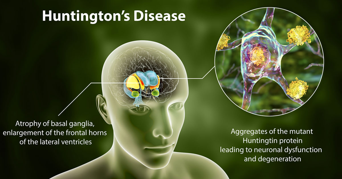 Huntington’s Disease